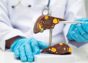 Cholestatic Liver Disease and Hyperlipidemia 