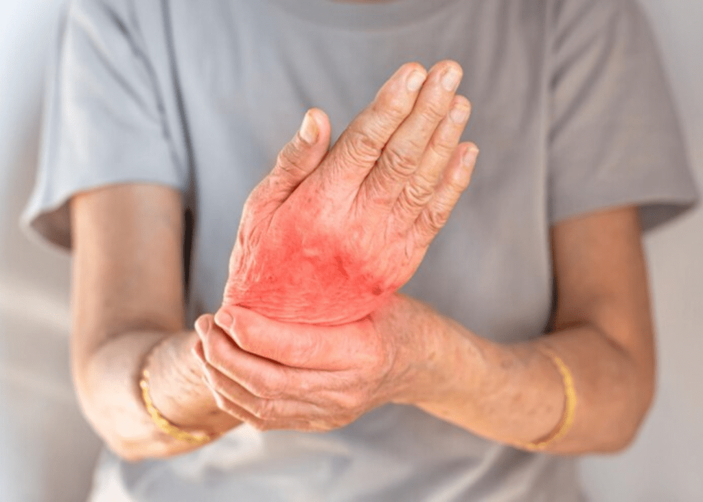 saccharolytic arthritis